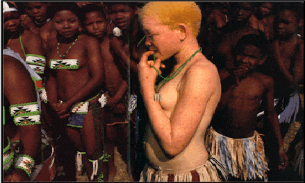 Albinos en Afrique : une « tare » mortelle