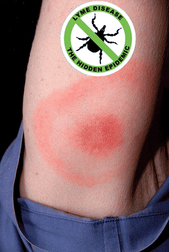 La maladie de Lyme, camouflée par les autorités ?
